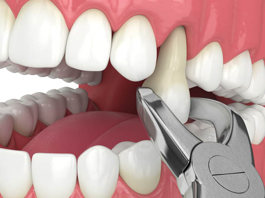 Tooth Extractions Hallandale Beach, FL